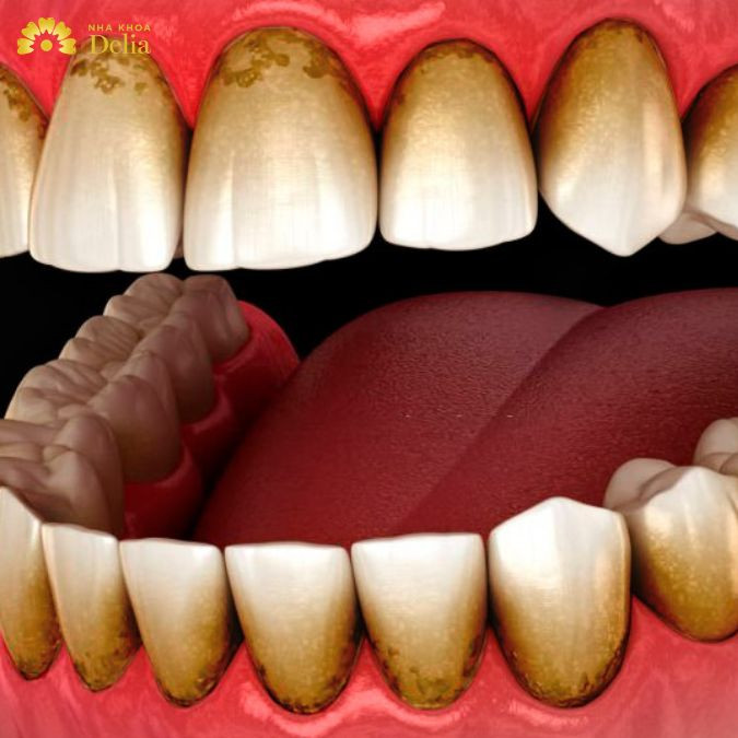 Răng bị đổi màu, ngả vàng do nhiễm màu kháng sinh hay các loại thuốc khác nên bọc sứ