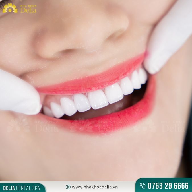 Kỹ thuật dán sứ đòi hỏi tay nghề cao nên giá cả dịch vụ này không hề rẻ