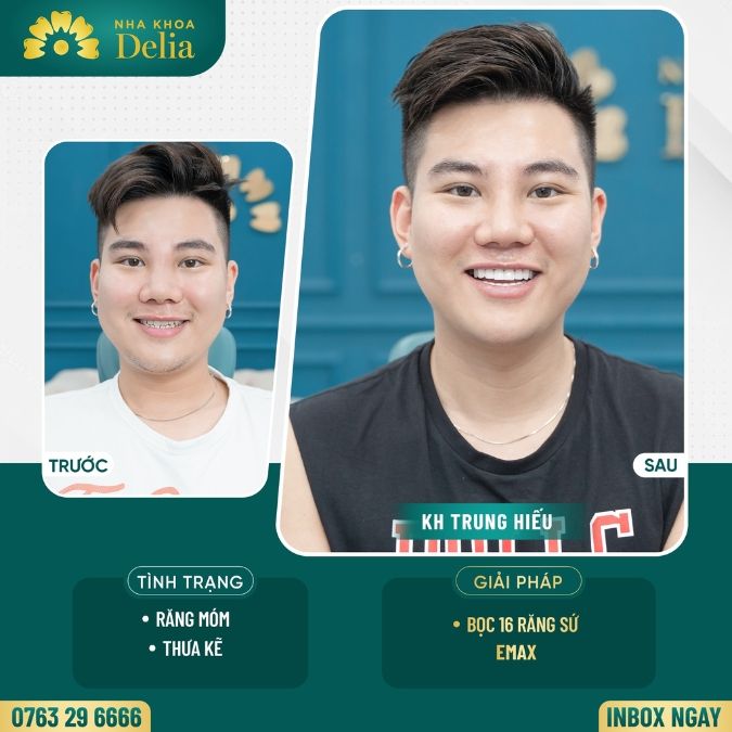Chọn loại răng sứ phù hợp với nhu cầu
