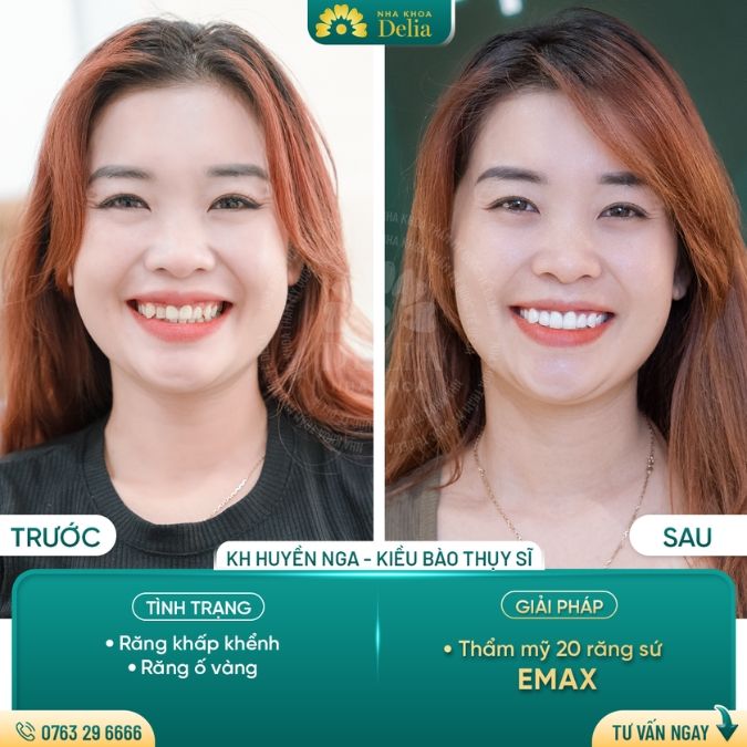 Giá bọc răng sứ Emax