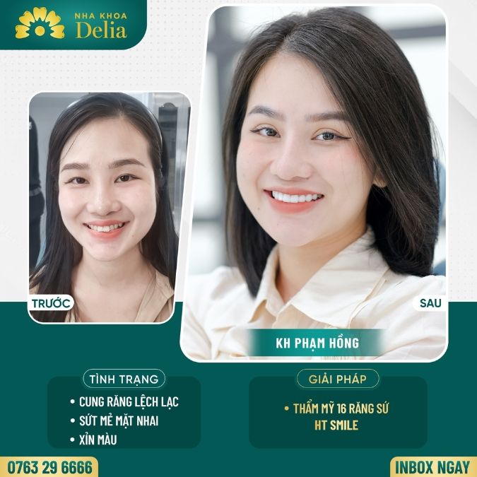 Giá bọc răng sứ dựa trên số lượng răng cần bọc