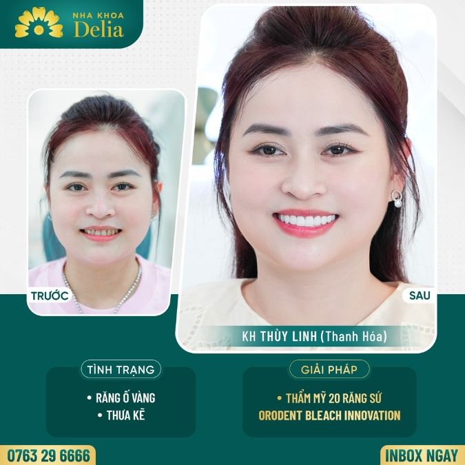 Giá bọc răng sứ dựa trên vị trí bọc răng sứ