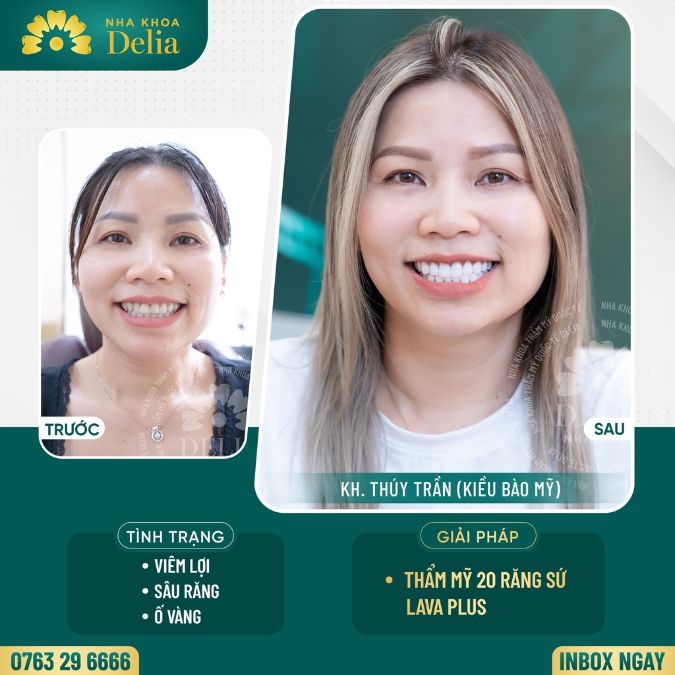Giá bọc răng sứ Lava